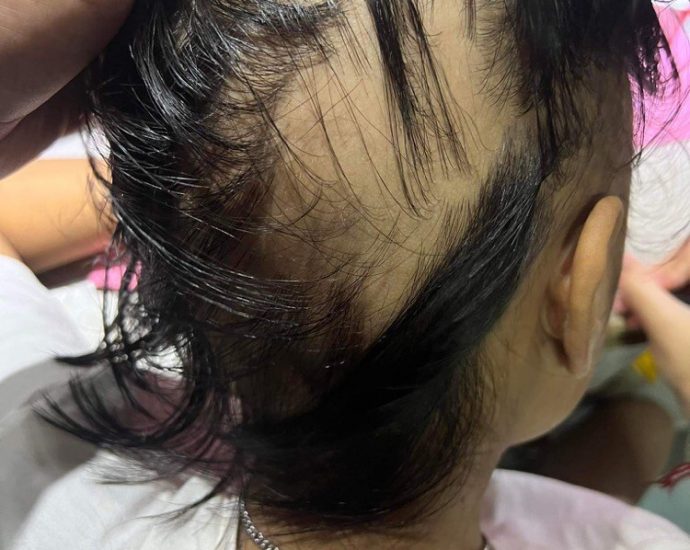 Doctors seek answers after girl loses hair following Covid