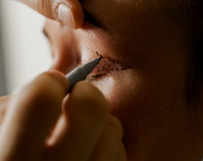 Man unhappy with his eyelids post-surgery, sues plastic surgeon and clinic but fails