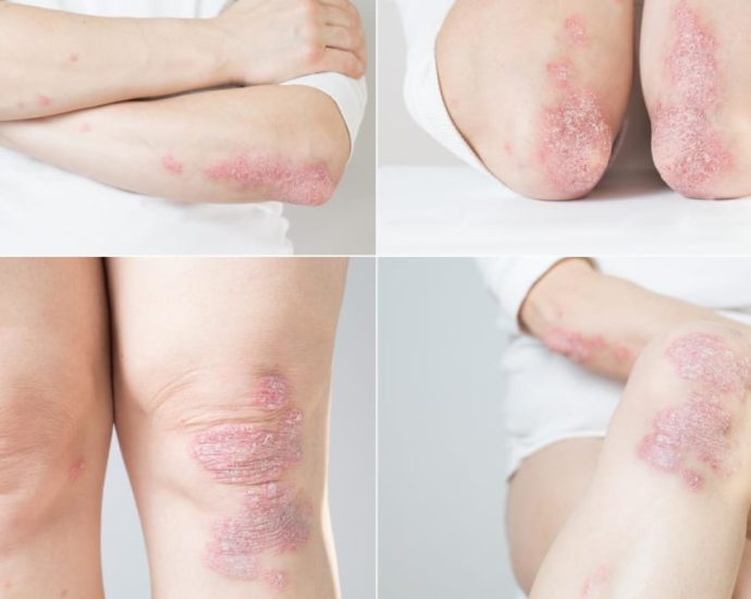 How can you tell if your itchy rash is psoriasis and not eczema? What are the treatments available?