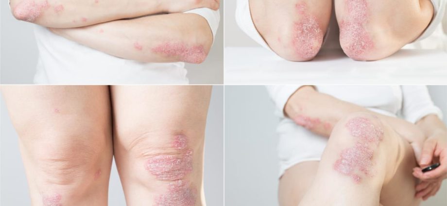How can you tell if your itchy rash is psoriasis and not eczema? What are the treatments available?