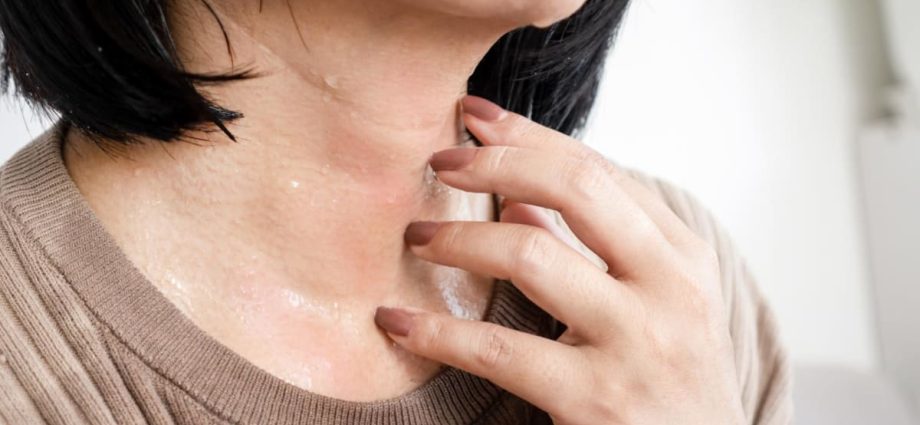 Suffering from eczema? 7 ways you can cope with the worsening heat and humidity