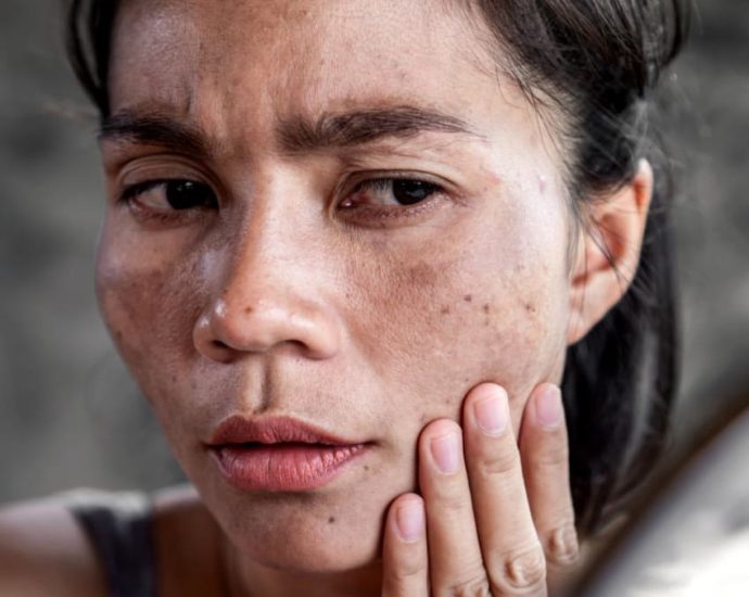 Melasma isn’t just a pregnancy thing, it can happen to any woman. And it’s all because of our hormones