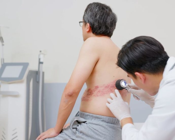 Some Singapore doctors see more patients with shingles over past 2 years