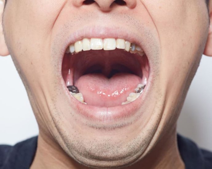 You could start losing teeth in your 30s – how to keep the rest of them before it’s too late