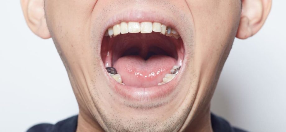 You could start losing teeth in your 30s – how to keep the rest of them before it’s too late